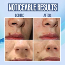 Load image into Gallery viewer, Facial Spots Removal Pen
